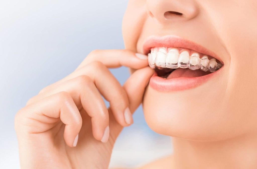 A woman putting in Invisalign to help straighten her teeth.