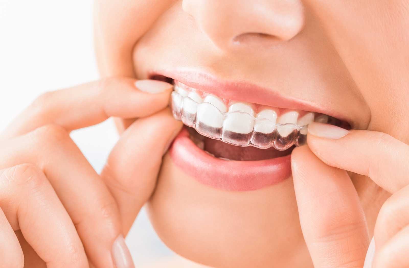 What You Can & Can't Eat with Invisalign | Calgary