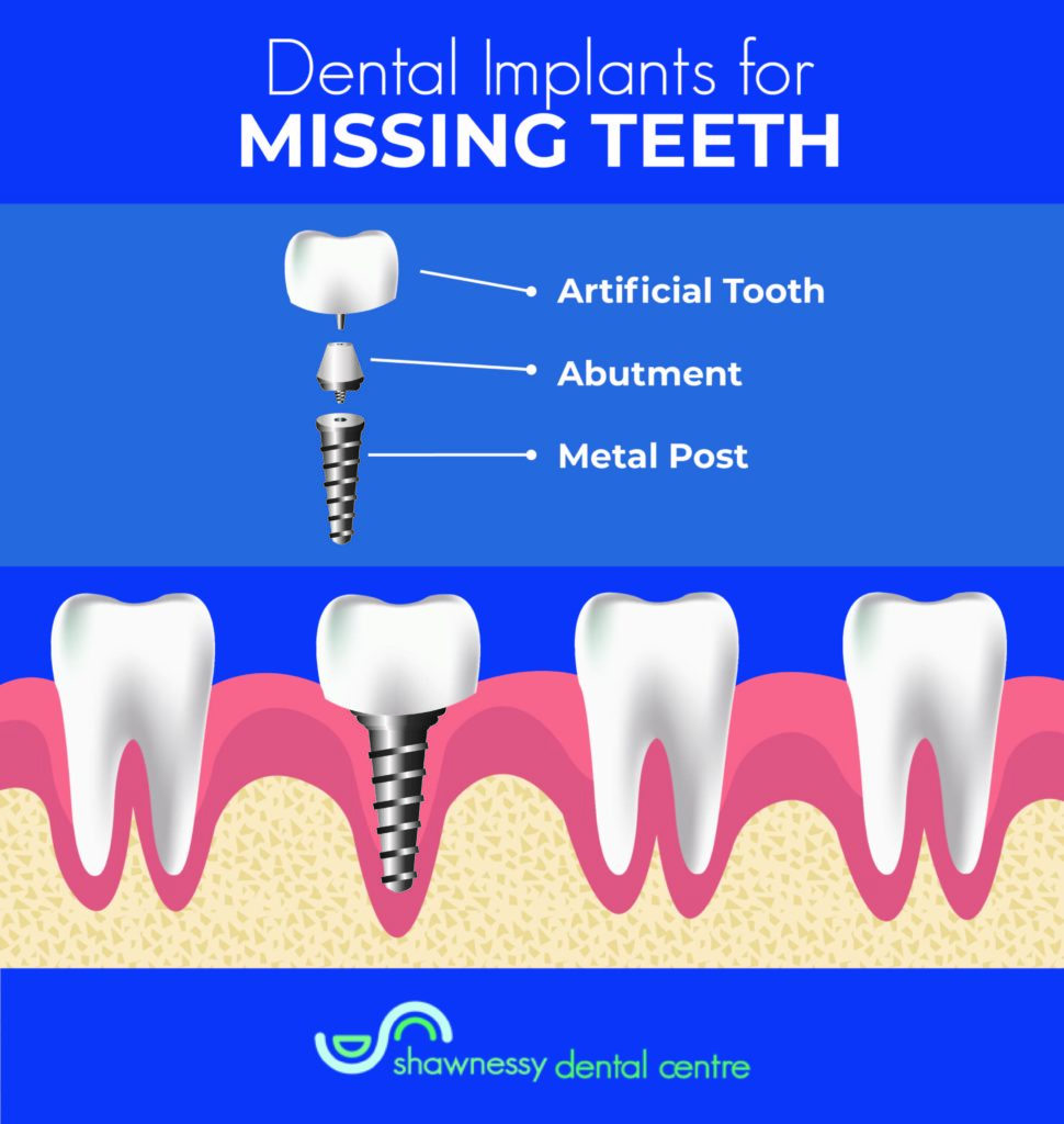 The three different components of a dental implant