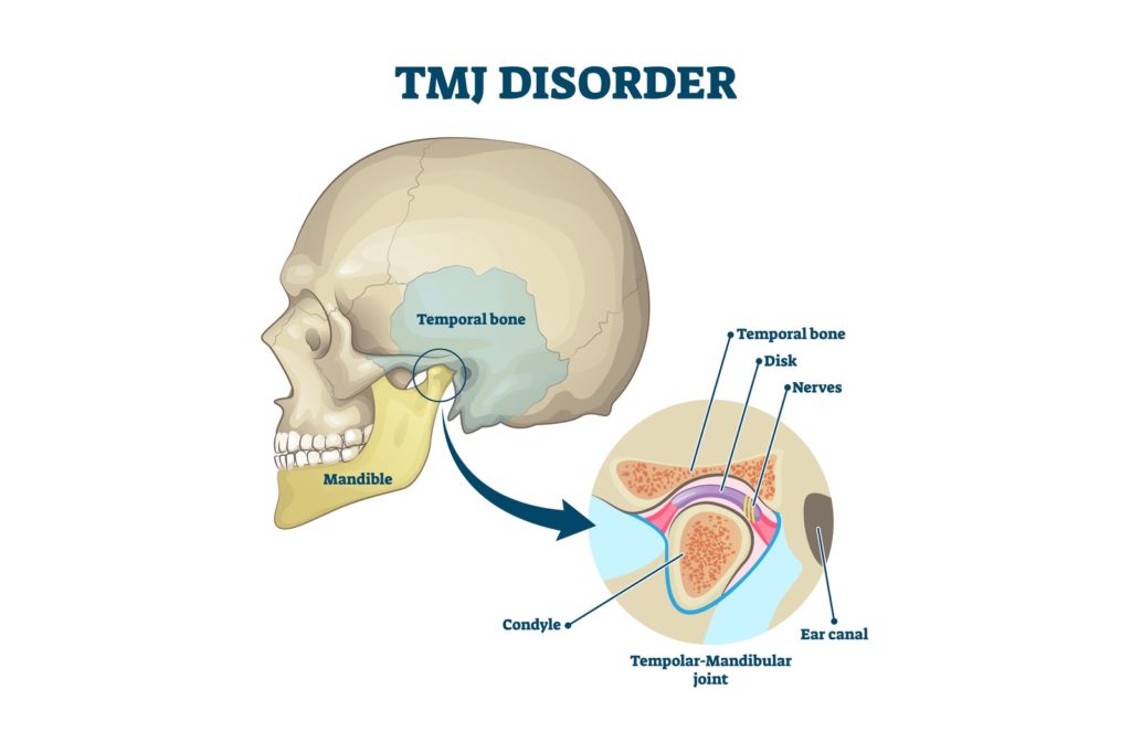 TMJ illustration showing labeled jaw with explanation.