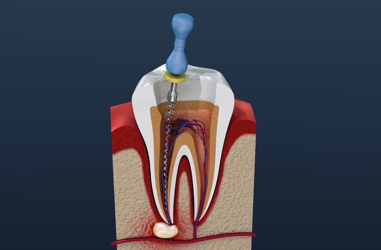 root canal procedure