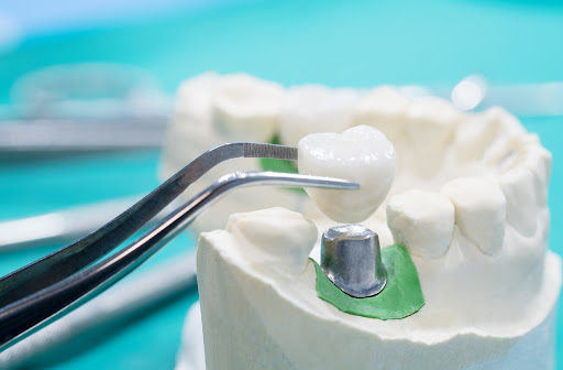 3D illustration of dental crown being used on model.