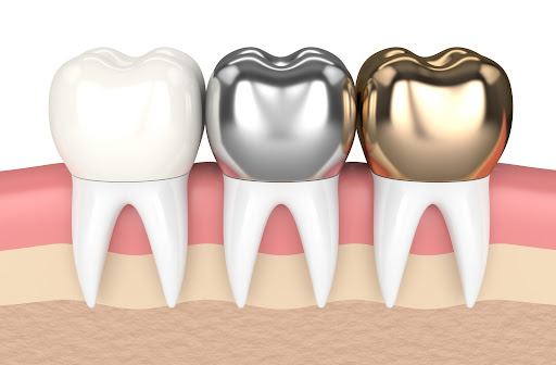 3D illustration of different dental crowns made from different material.