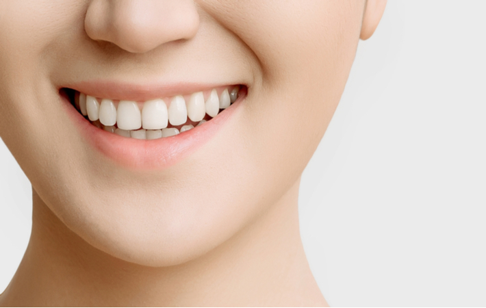 Close up of women smiling with dental veneers