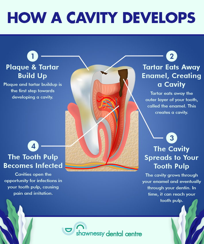 The 4 steps as to how a cavity develops 