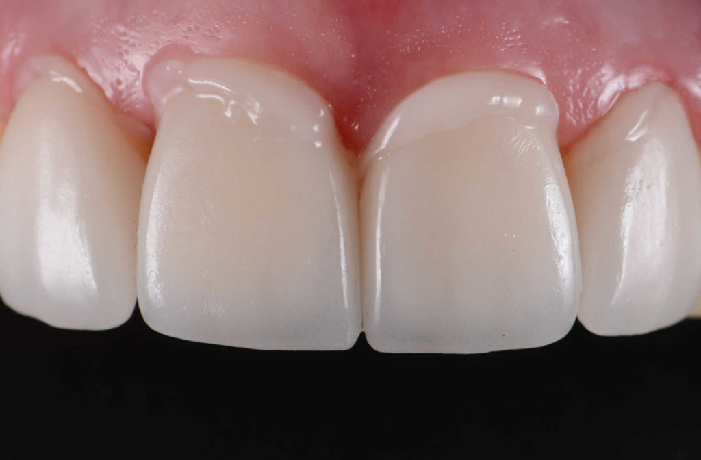 Dental Bonding done on the upper denture to treat tooth sensitivity.