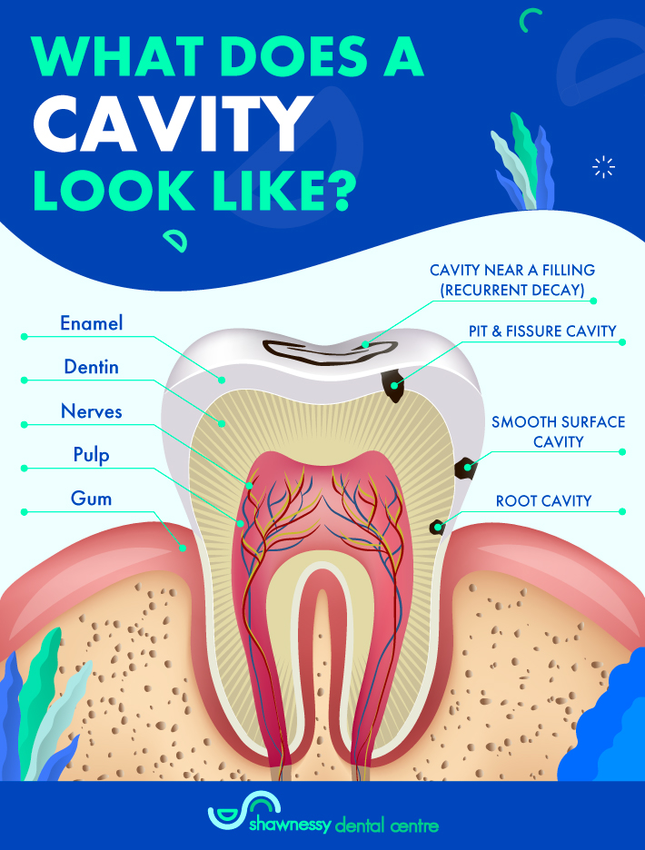 An infographic to show the various parts of the tooth and highlight the symptoms of cavity. 