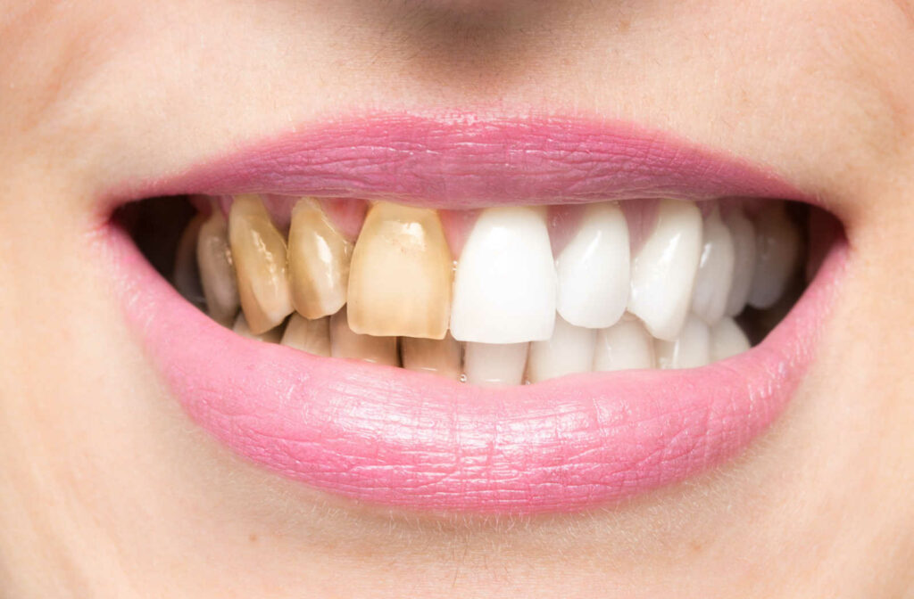 A close up of a woman's teeth with the left half of the denture stained brown.