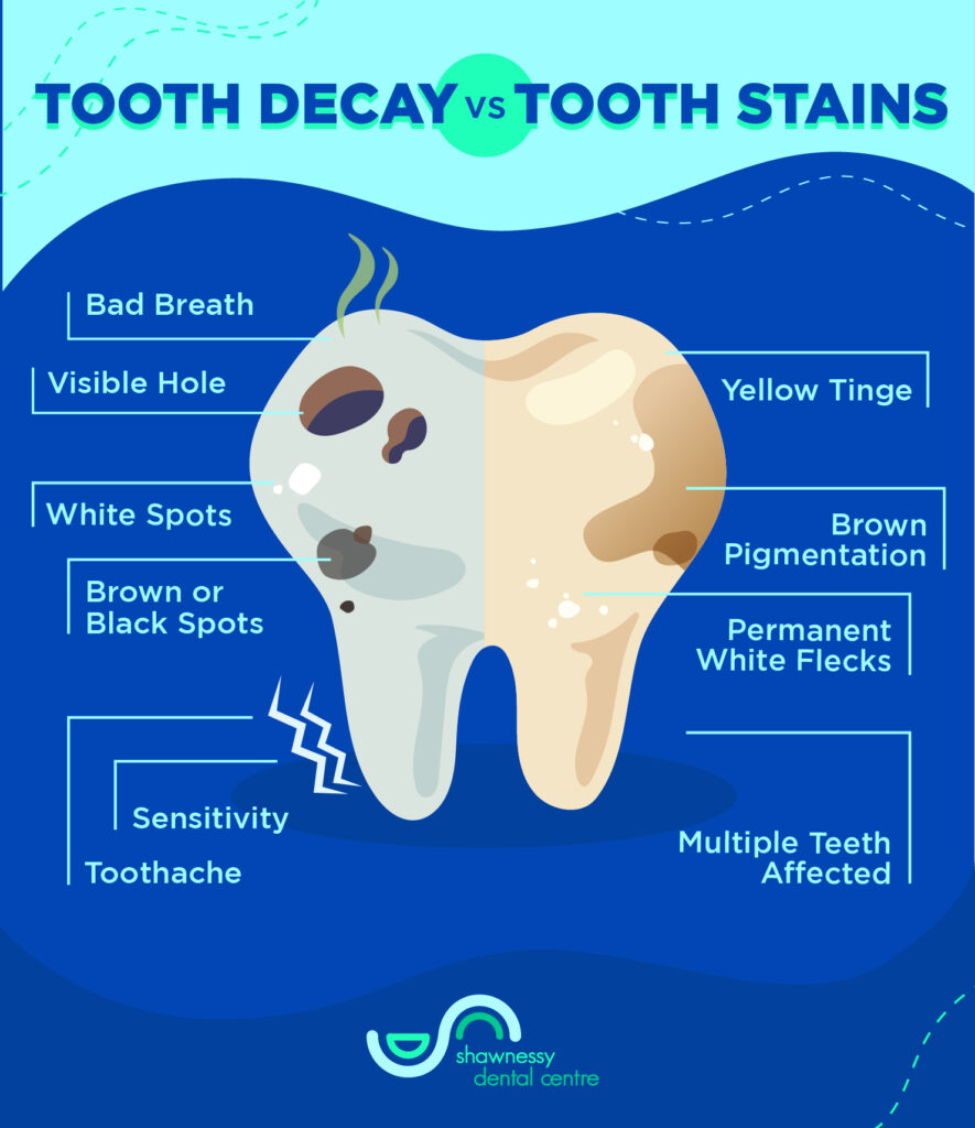 A pictorial representation of differences in symptoms of tooth decay and tooth stains.