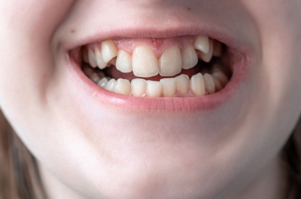 A close up view of a child's mouth showing crooked teeth.