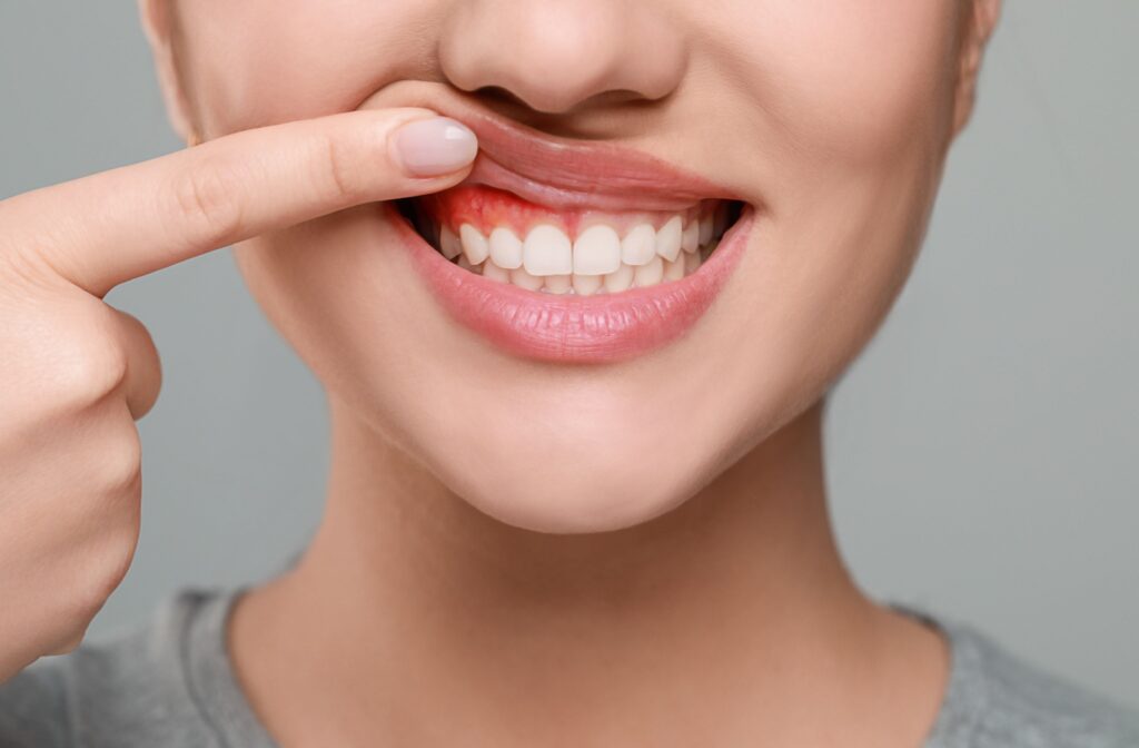 Close-up of a person's mouth as they use their manicured index finger to lift the right side of their mouth to show inflamed gums