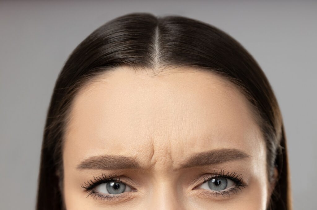 A close-up view of a woman's forehead showing frown lines between the eyebrows.