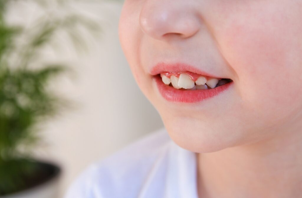 Close-up of a young child’s mouth showing crowded and overlapping teeth.