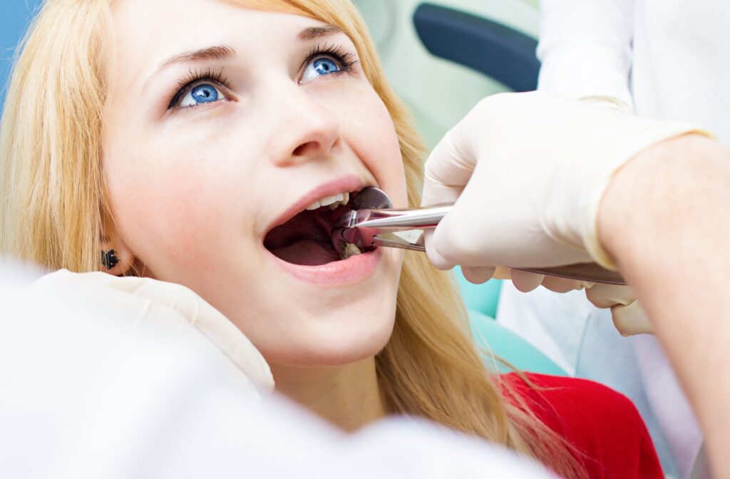 Dentist performing molar extraction with dental forceps.