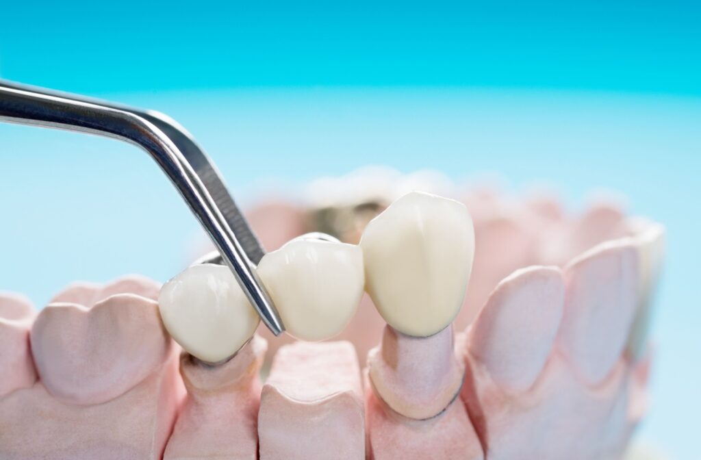 Dentist placing a dental restoration on a model, showing options for replacing missing teeth